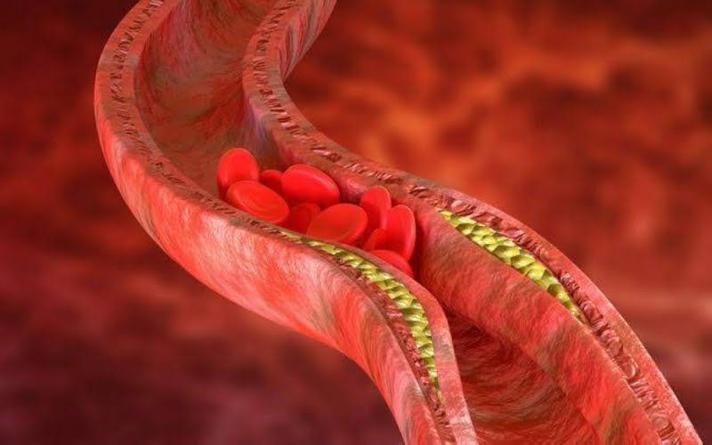 علامة تظهر على الرقبة تؤكد إرتفاع الكوليسترول في جسمك لمستويات خطيرة ويجب عليك التوجه للطبيب فوراً