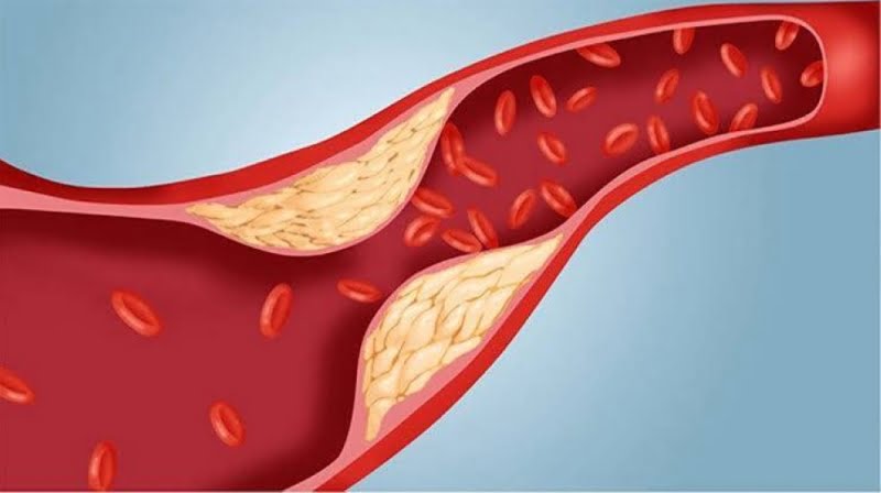 علامات تظهر في الجزء السفلي من جسمك تخبرك بارتفاع خطير في الكوليسترول الضار